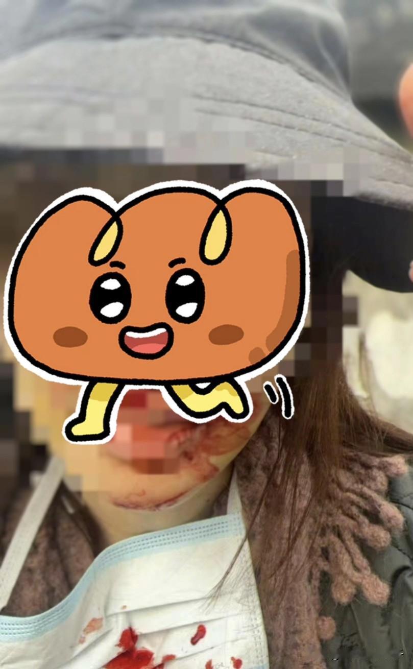 难怪金晨驾车肇事后着急离开，原来面部受伤如此严重！1月30日，对于网上爆料肇事