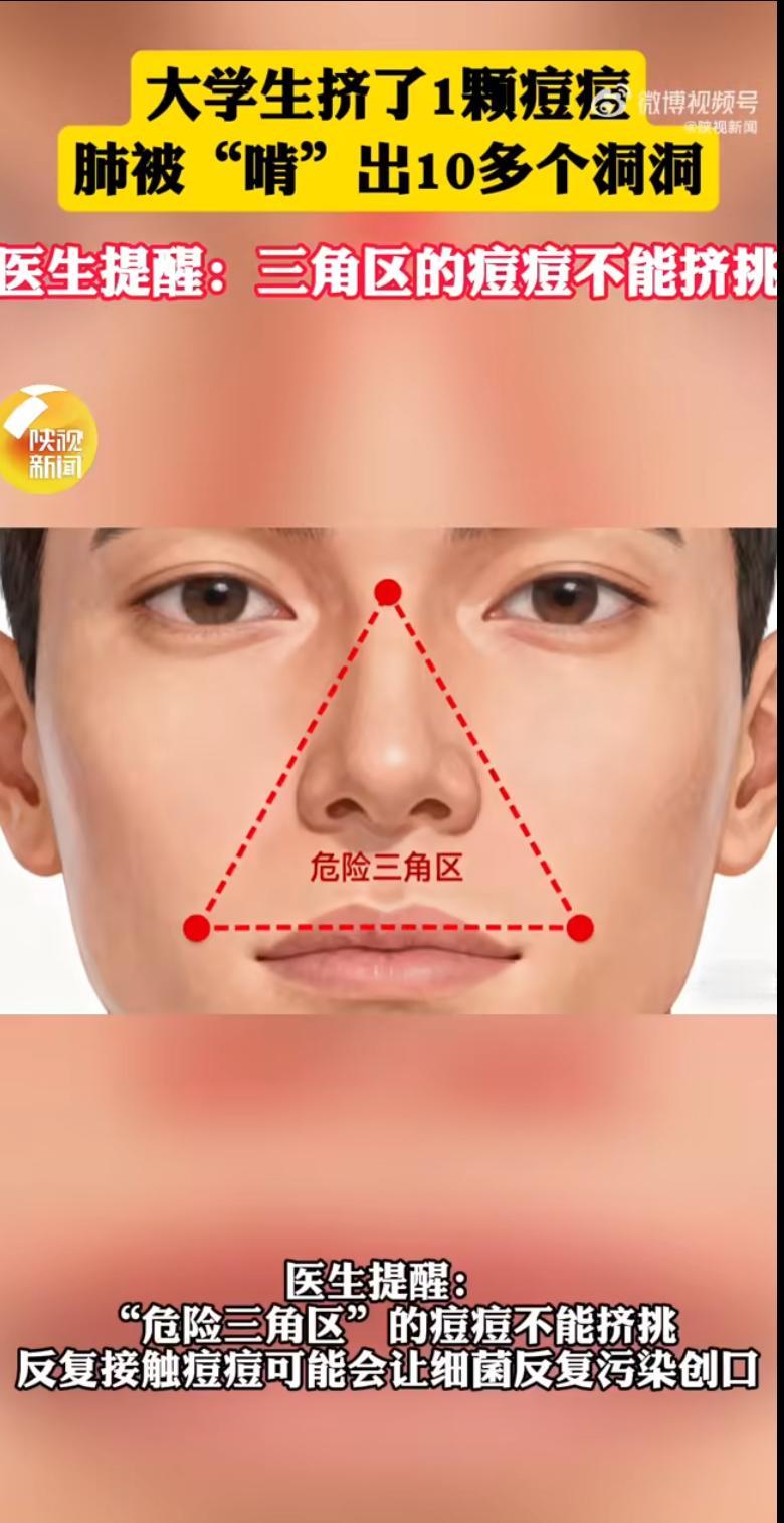 一则令人心惊的新闻冲上热搜：浙江宁波一名20岁大学生因挤了脸上一颗痘痘，肺部竟被