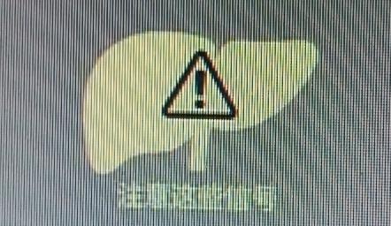 肝功能异常可不能小瞧，身体出现这些表现得重视起来。皮肤和眼睛发黄是明显征兆，医学