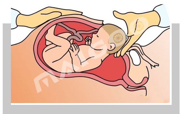剖腹产的妈妈们要注意了