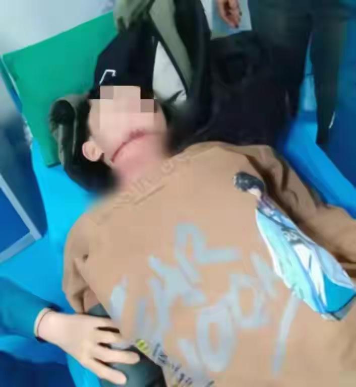 河南那个13岁被绳割喉的男孩转入普通病房，他活了！真是好消息！13岁男孩