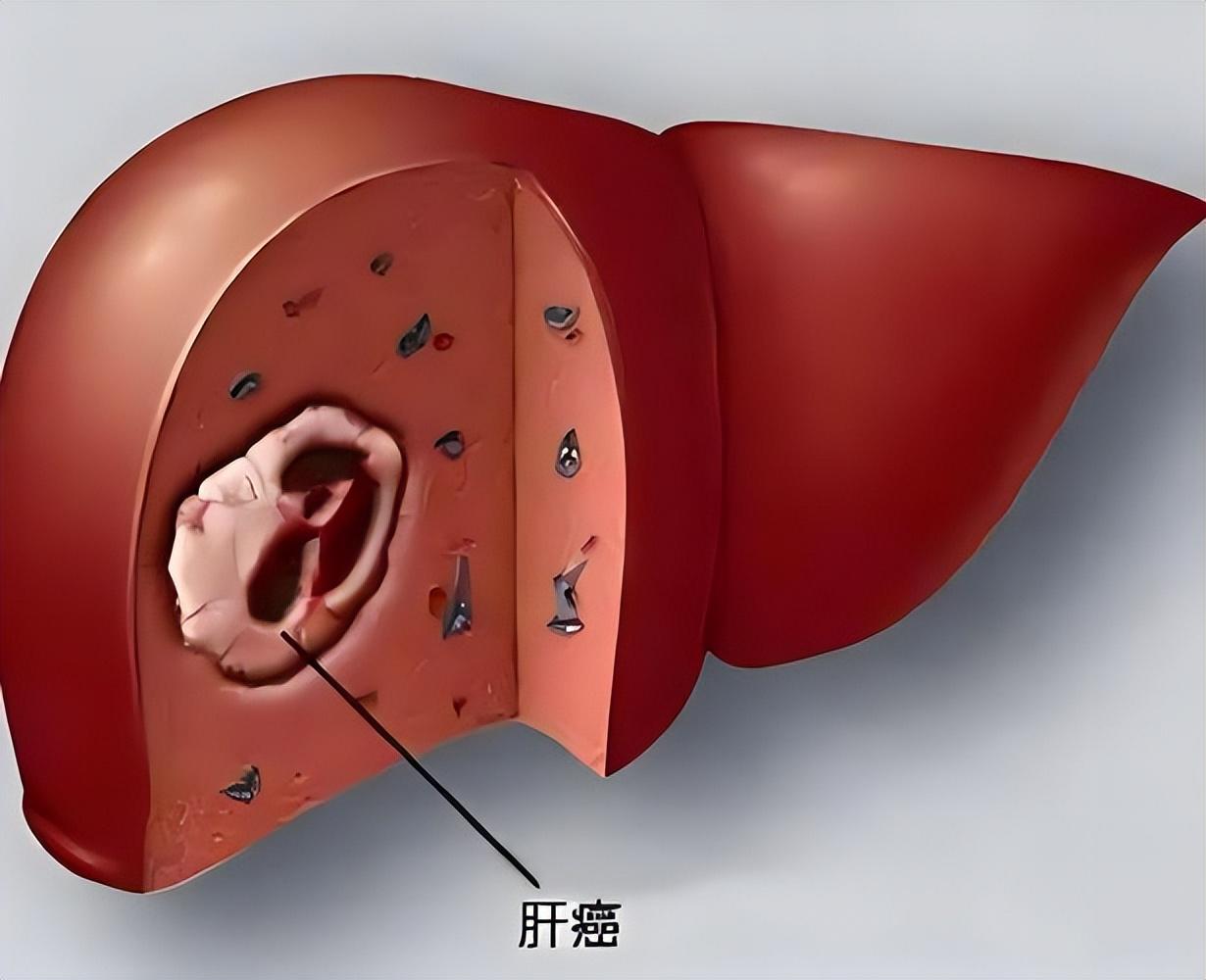 医生统计百例肝癌死者，发现肝癌规律：易患癌的是这4类人群二甲双胍是目前全球用