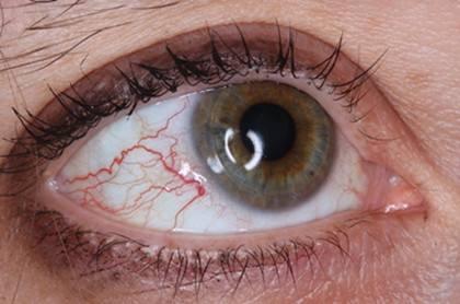 在健康人的眼睛里,事实上也布满了特别微细的血管,只是因为特别的