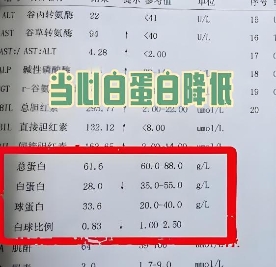 肝病患者白蛋白低不知道怎么办？ 肝病患者如果白蛋白偏低，说明体内的白蛋白