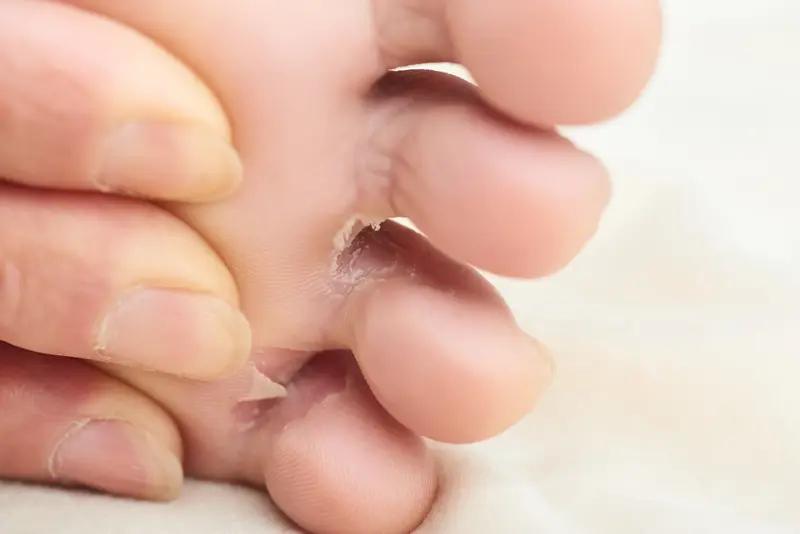 糖尿病患者烂脚趾，其实是糖尿病足的表现。这主要有三方面原因。一是神经病变，长期