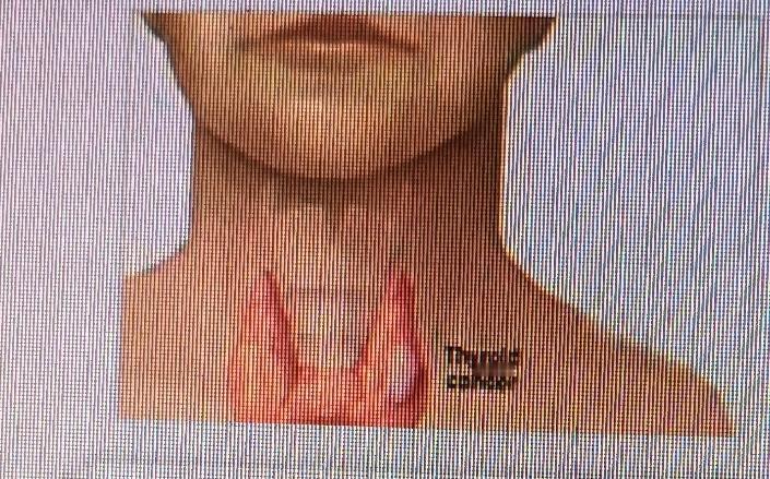 甲状腺有问题的宝子们，饮食可得上点心！有些食物真得少吃。高碘食物像海带、紫菜这些