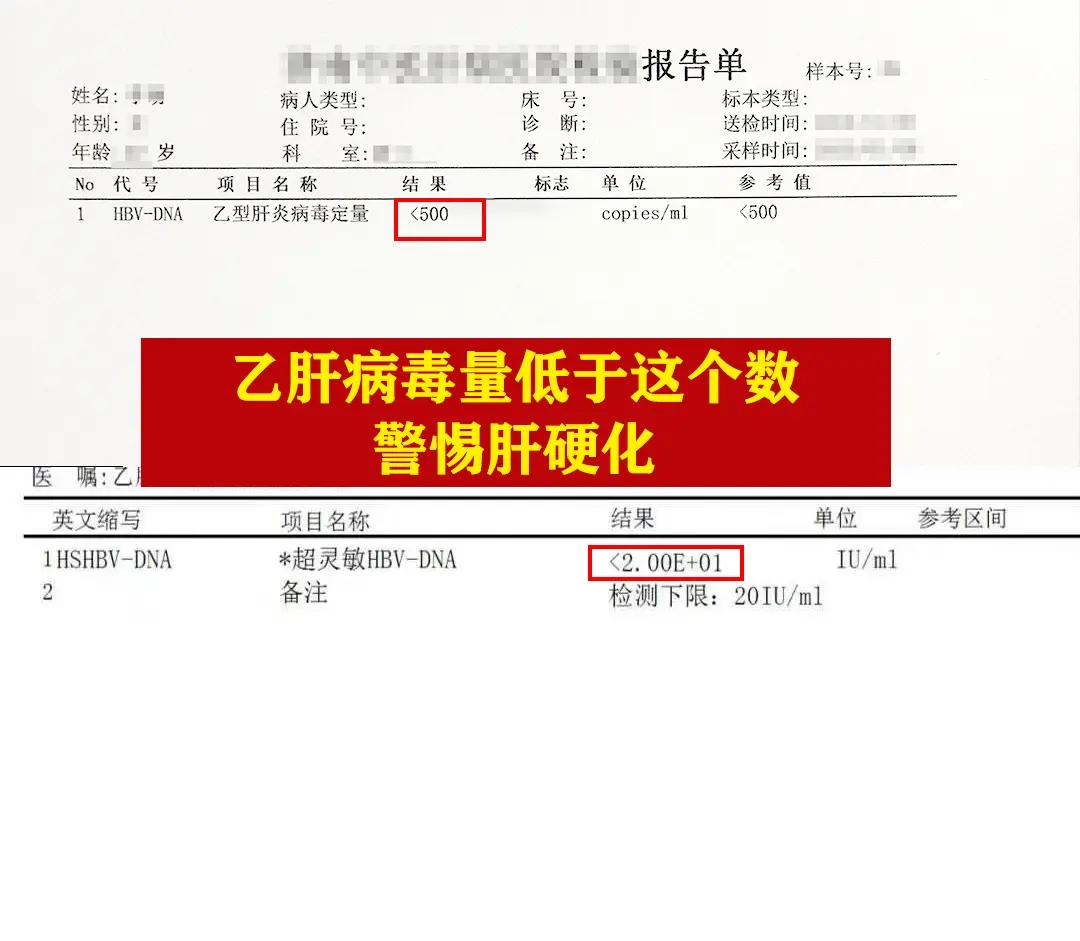 吃着抗病毒药还是查出肝硬化，实在令人惋惜。可能很多人觉得是药的问题，经...