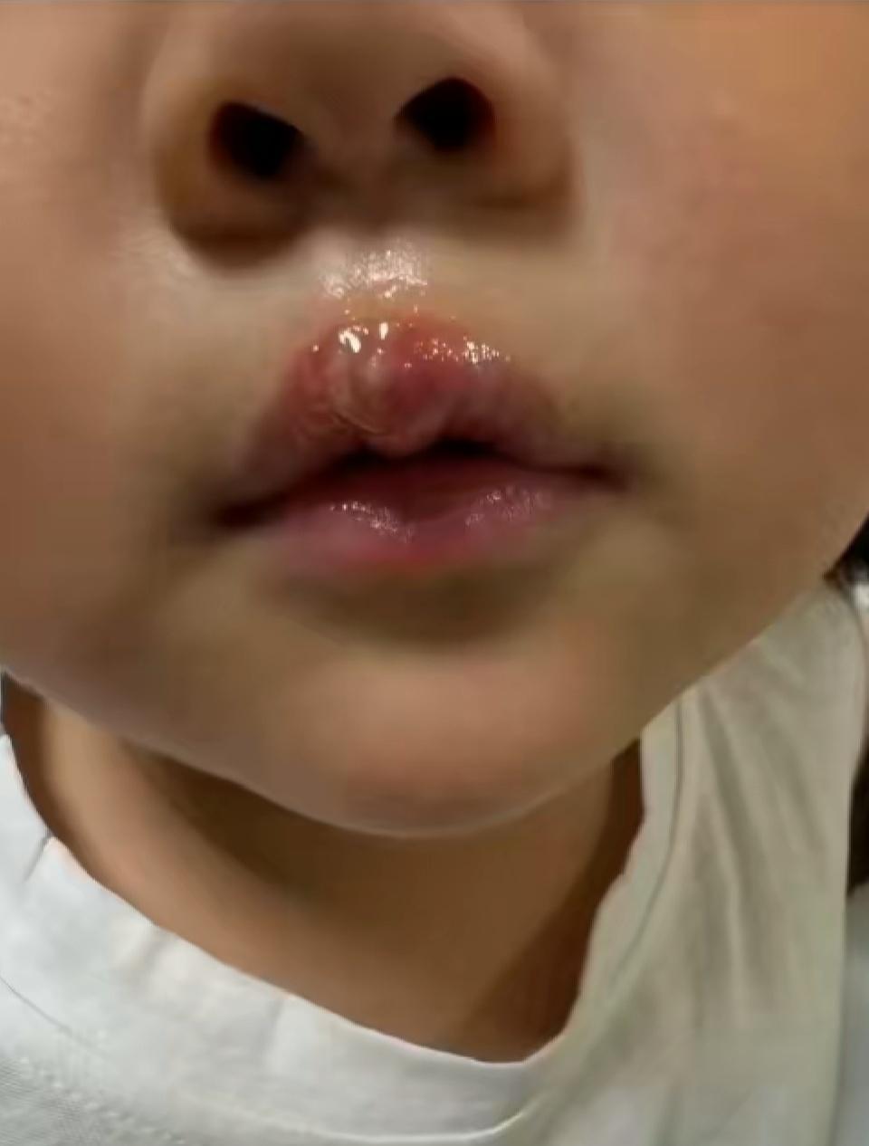 幼儿园老师竟然用热熔枪烫坏孩子嘴巴！发生在某地的这起幼儿园老师虐待孩子的事情实在