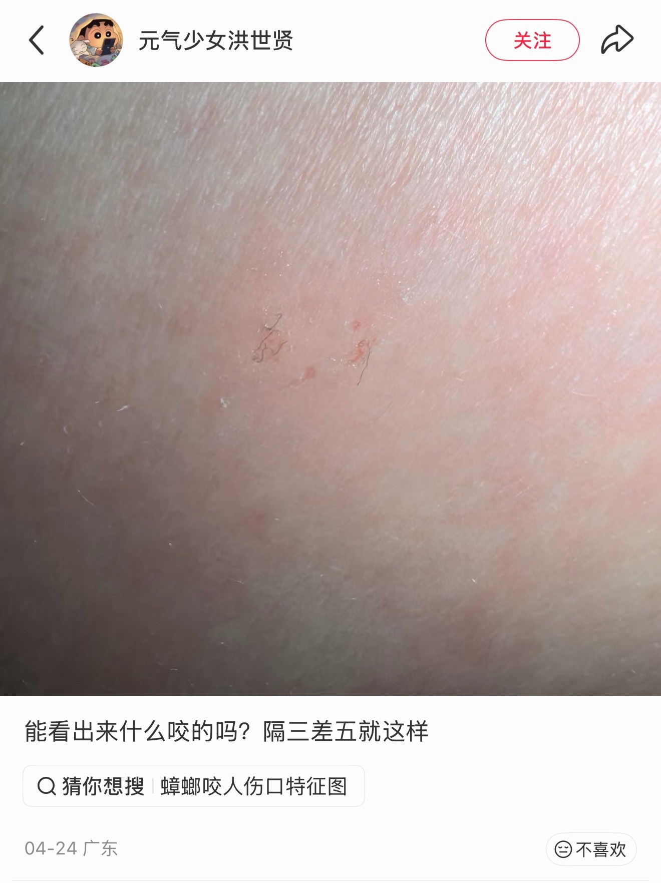 虽然我在广东生活挺久，但是看到蟑螂咬人的画面还是第一次