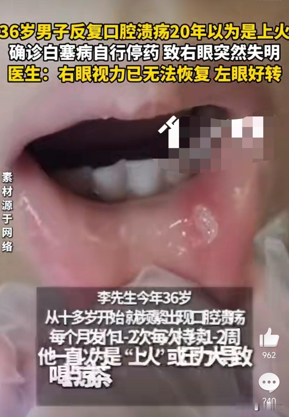 口腔溃疡20年硬扛！36岁男停药致右眼瞎，这病根本不是上火刷到这新闻我后背