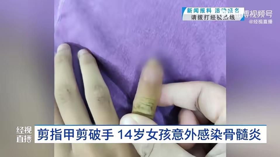 “悲剧还是发生了！”2025年8月，湖北武汉，一女孩在家剪指甲时，不小心剪破了小