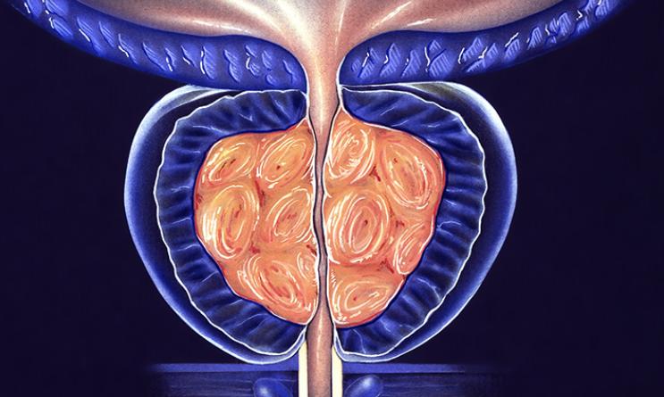 【前列腺增生三味猛将：先通、再散、后利，气血通了，结滞松了，排尿畅通无阻！】