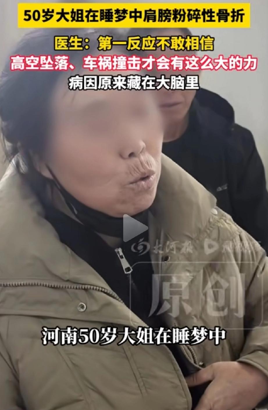 不敢相信！河南，50岁的张大姐，睡梦中肩膀突然粉碎性骨折，骨头碎成七八块！医生起