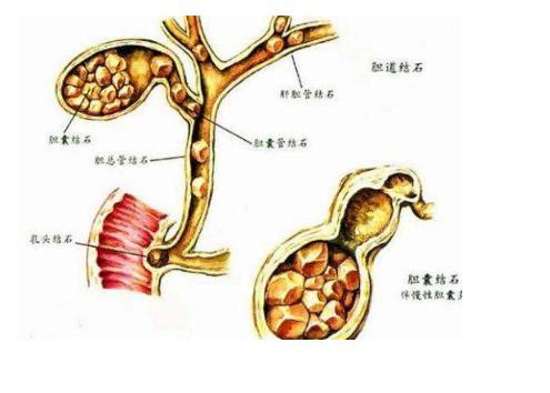 胖了容易胆结石，瘦太快也容易？胆囊最怕两个极端 很多人以为胆结石跟减肥没关系