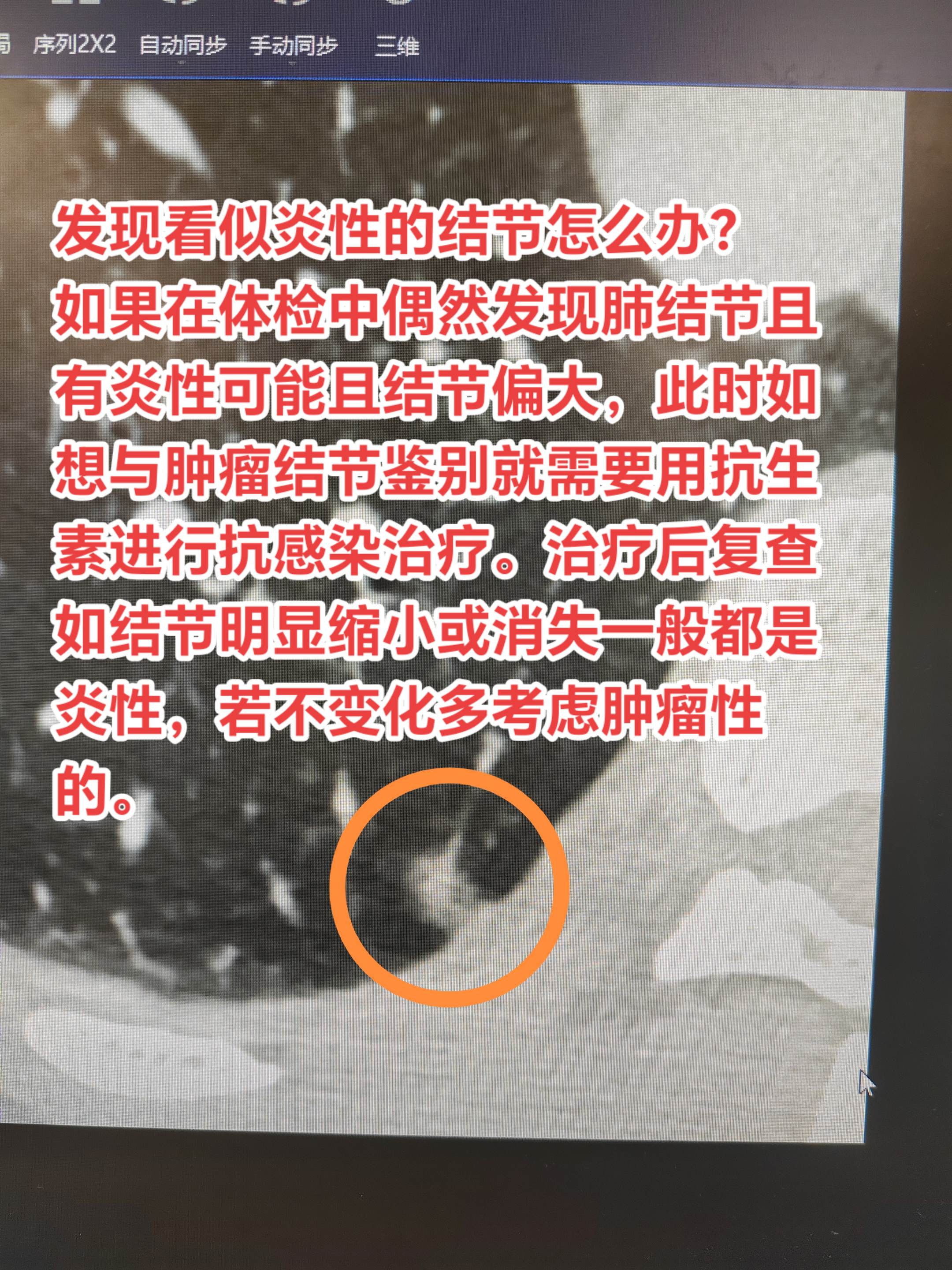 发现看似炎性的结节怎么办？如果在体检中偶然发现肺结节且有炎性可能且结节...
