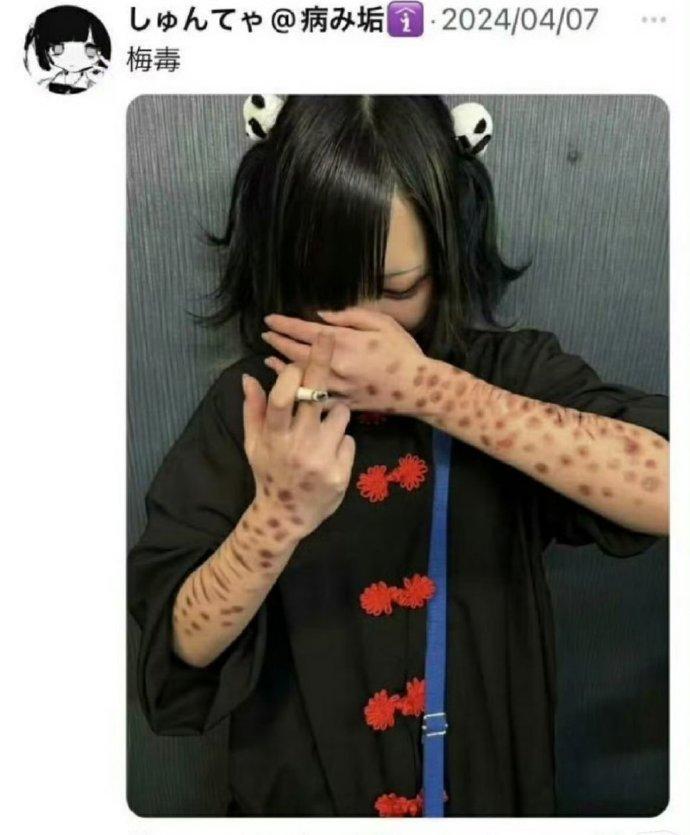 日本年轻人集体晒梅毒红疹！4年超1.3万例，病态潮流藏致命坑作为盯健康热点