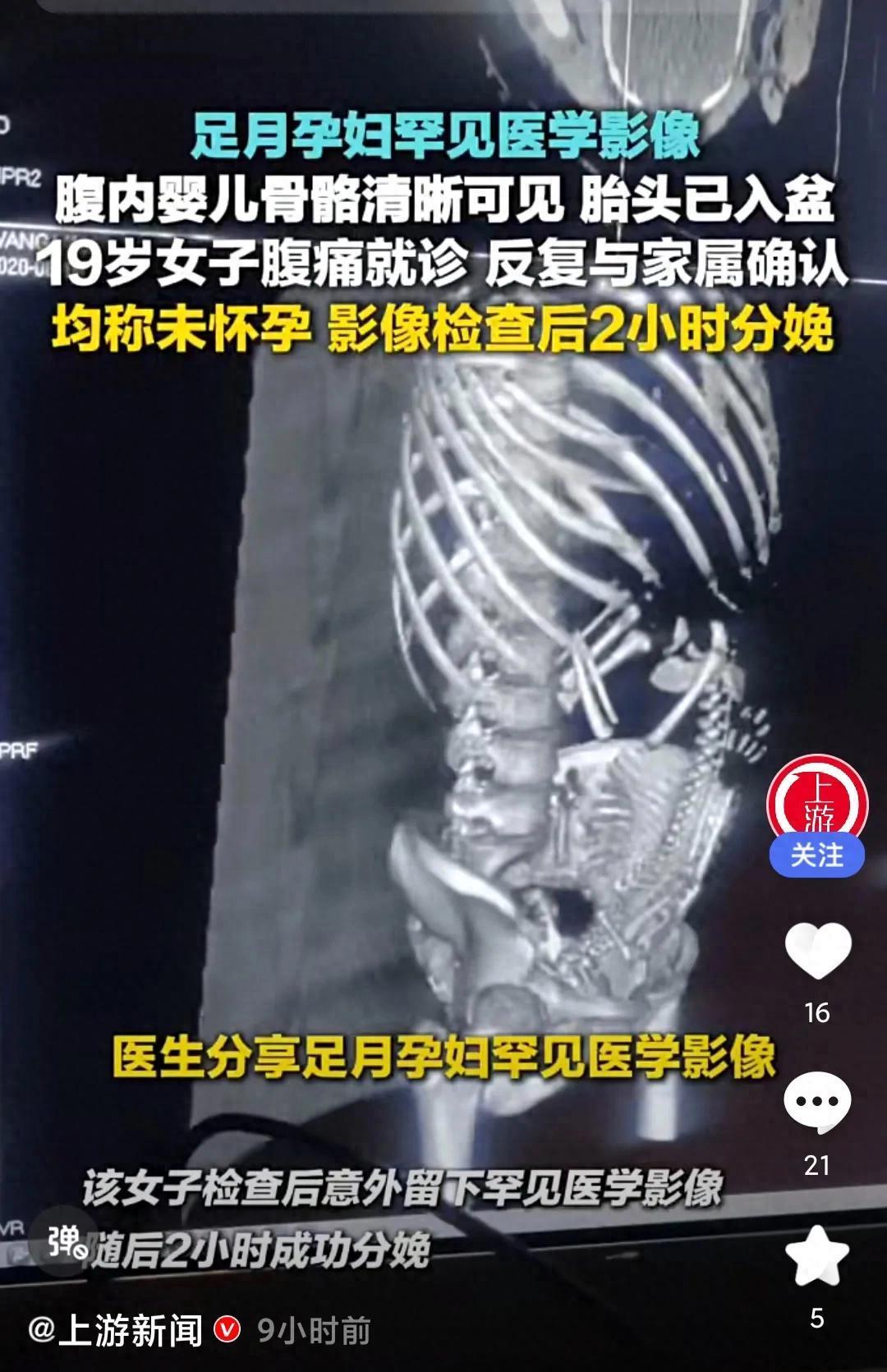 19岁女孩腹痛就医，两小时后产子，如何帮女孩顺利度过青春期？一张医学影像片上，