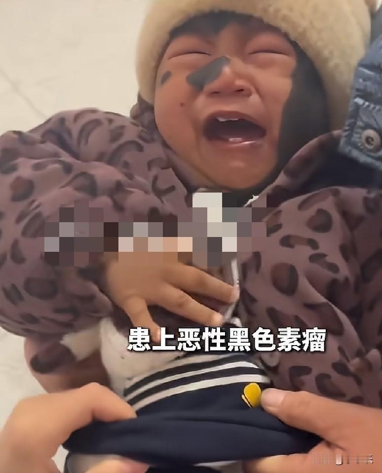 6月13日，“兽皮痣”患儿小乐宝离世，妈妈发布的讣告让人心碎，妈妈在讣告中说:“