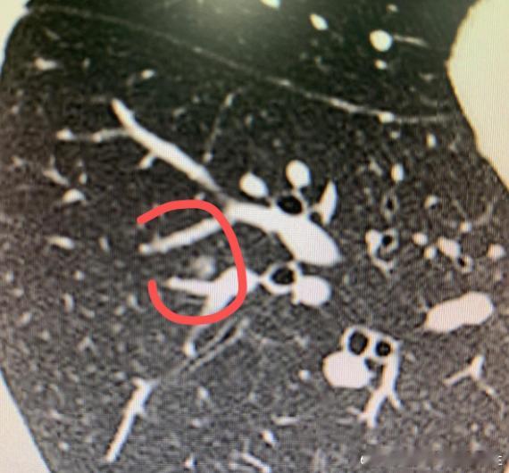 这位49岁的女患者，因为父母都曾患过癌症，所以一直很重视身体，每年坚持...