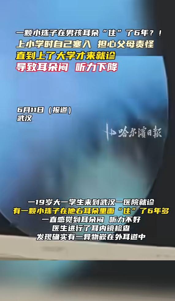 “心真大！”6月11日报道，湖北武汉，一男生在上小学时，将一颗珠子塞进耳朵，因为