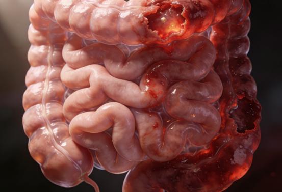 肠易激反复发作？这个方子要收好！为你暖肾健脾、安肠胃 很多肠易激的人都有同一