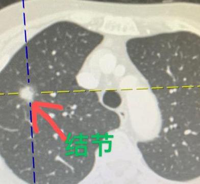 门诊来了一位74岁的阿婆，是她儿子陪着来的，看起来精神不太好，脸上挂满了忧虑。她