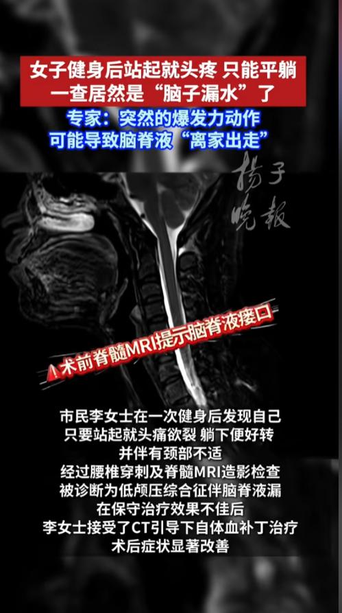 “万万没想到！”6月29日报道，江苏南京，一女子健身之后患上了个怪病，一站起来头