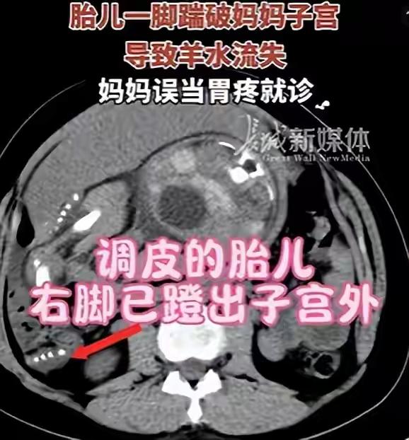 “魔童降世”，杭州一孕35周妈妈被胎儿踢破子宫误当胃疼，就医检查发现是罕见产科急