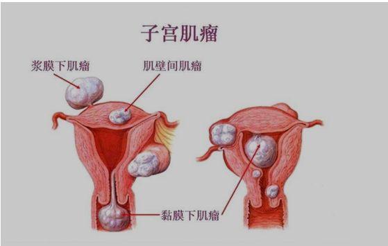 备孕女性最纠结的子宫肌瘤对怀孕有哪些影响