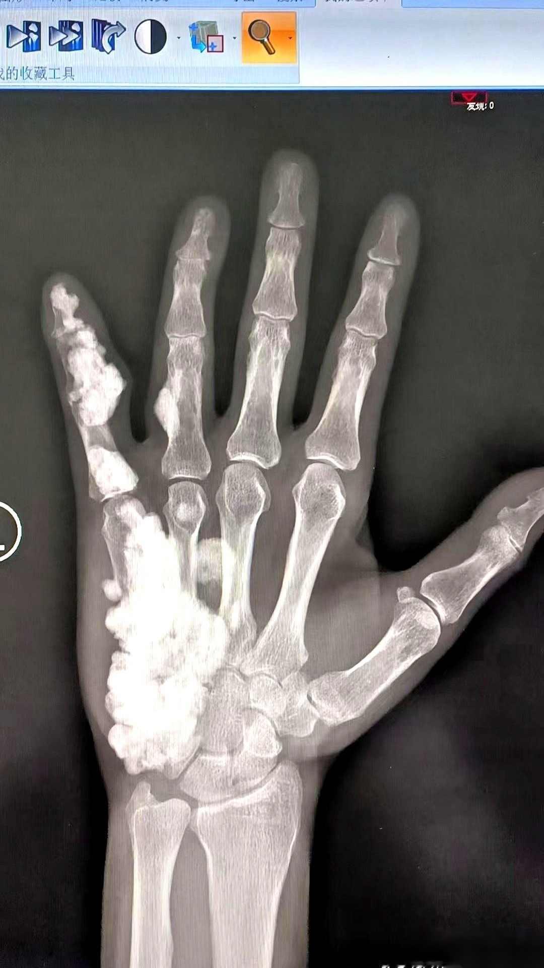 17岁，左手疼了整整10年。拍了个片子，我人都看傻了。医生把X光片递过来，我盯