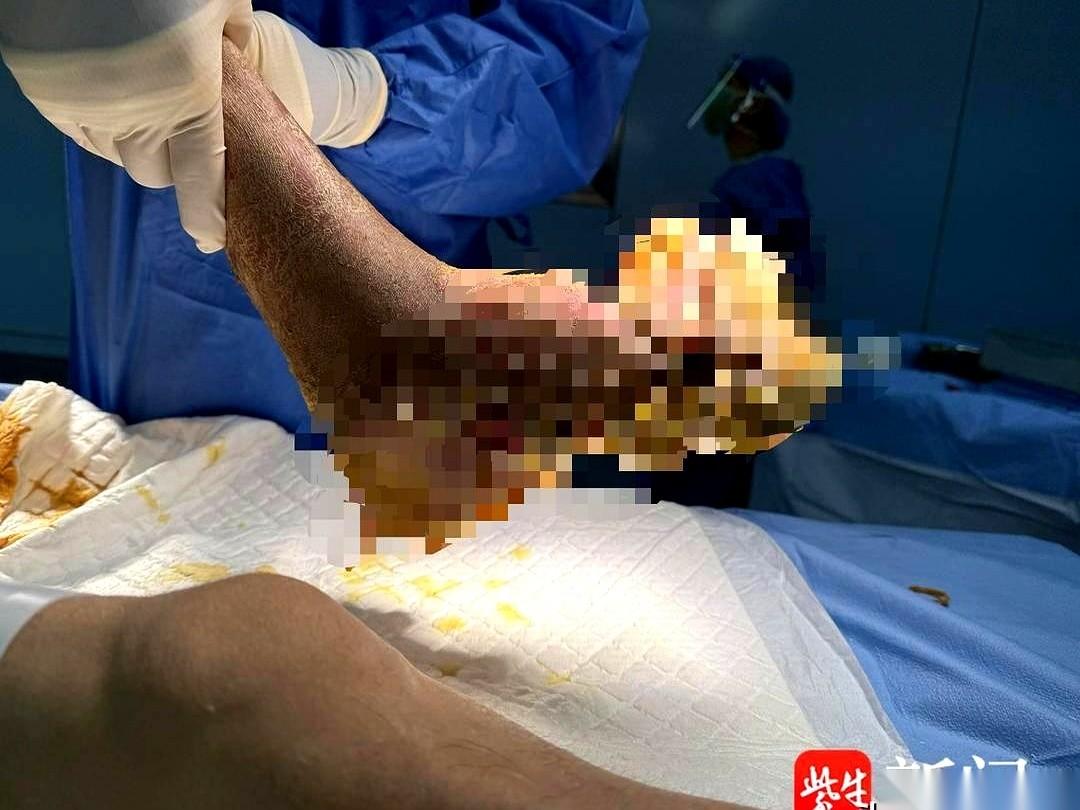 就因为抠脚。一个大男人，活生生把自己“抠”进了手术室。满脚长满“菜花”不说，
