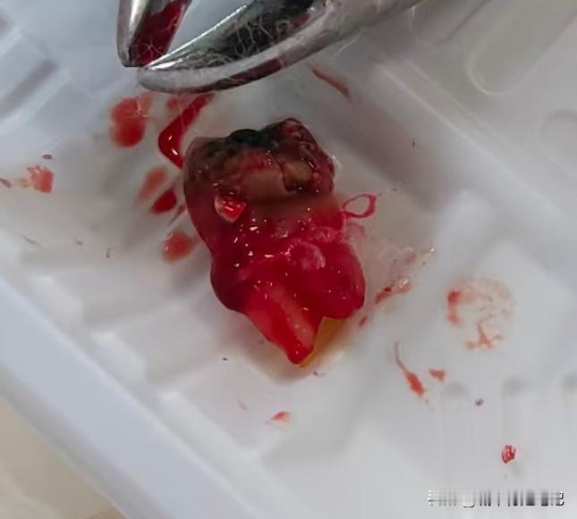 智齿虫蛀了，疼得厉害。去医院看，拍片以后医生建议拔牙。想到智齿也没什么用处，就花