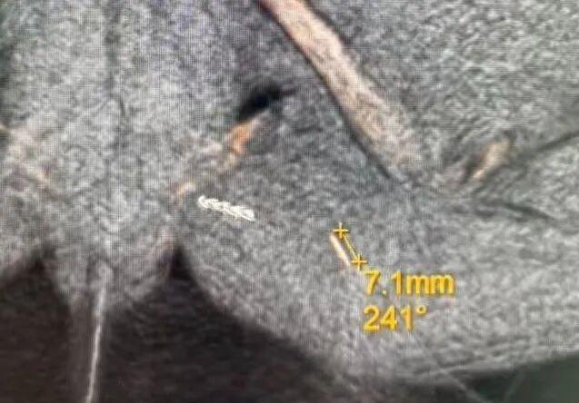 痛不欲生！广东深圳，62岁的黄阿姨被隐私部位的剧痛折磨得苦不堪言，两年来行走坐卧