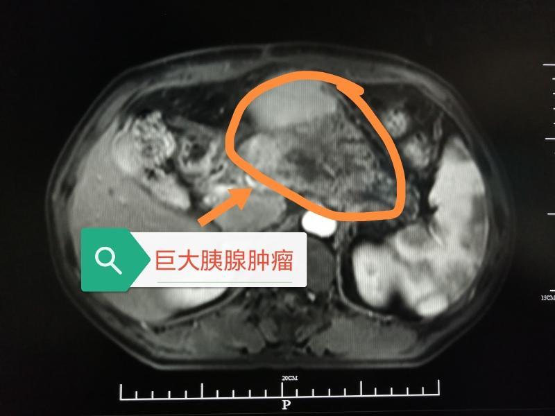 在治疗下,胰腺癌晚期能活多久?