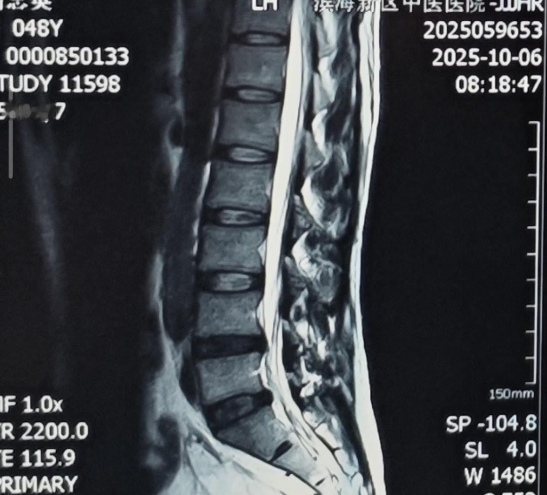 腰突住院3周治疗，今天终于可以出院了，虽然还没有完全好，但是能连续走路了，腰5骶