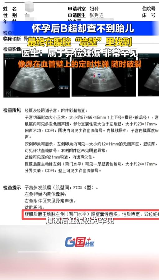 太惊险！广东深圳一女子验孕棒查出怀孕，抽血也确认妊娠，可B超始终找不到孕囊，