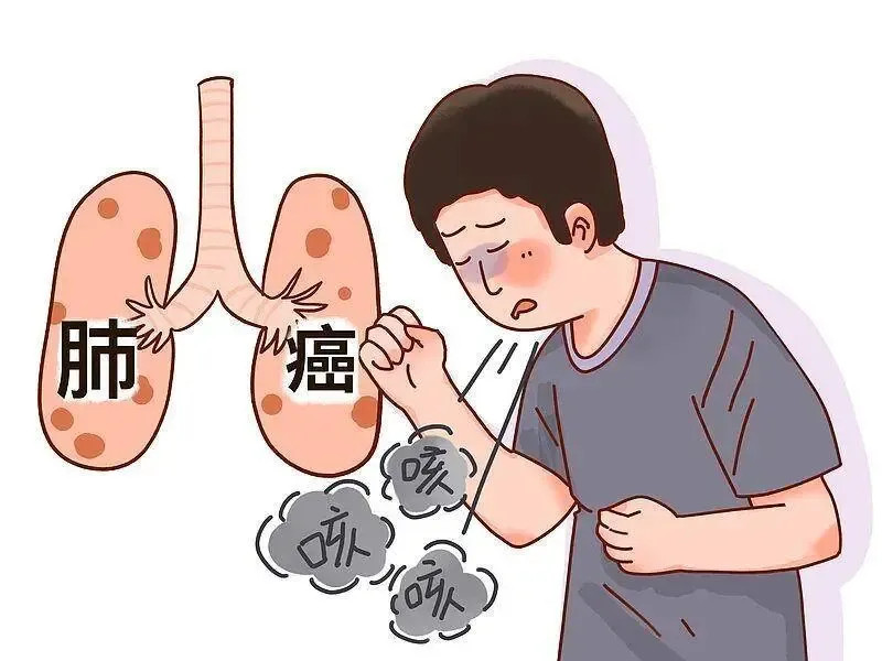 肺癌早期的症状早期肺癌最大的特点，就是"没感觉"。很多早期患者是在体检拍胸片或CT时偶然发现的，自己
