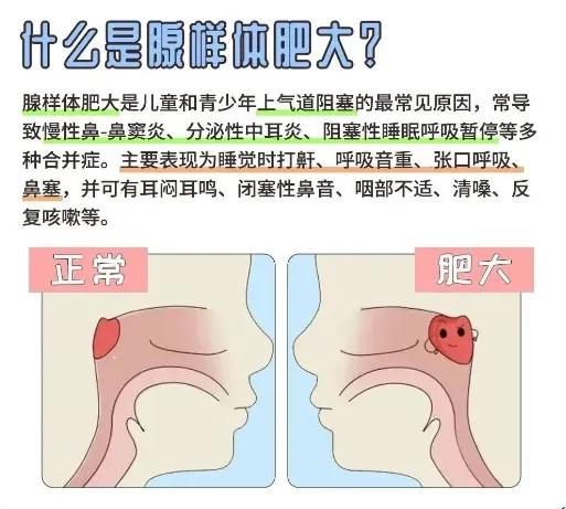 小儿腺样体肥大、鼻塞打鼾、张嘴呼吸，我一般这样搭配中成药使用，多看几遍，人人都可