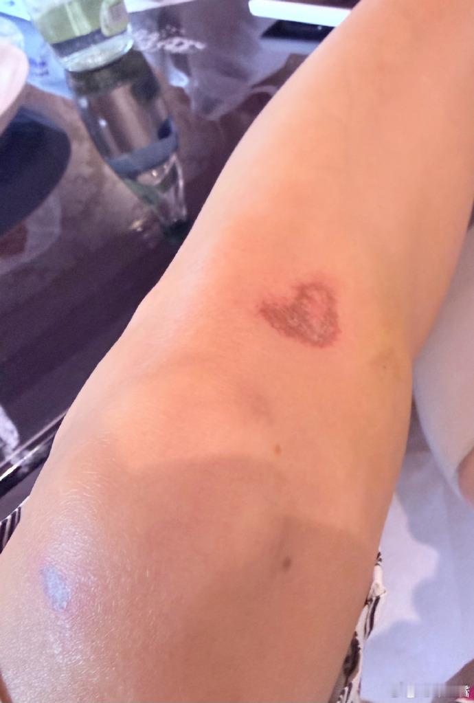 辛芷蕾骑车摔出了个爱心辛芷蕾说四肢全费辛芷蕾也太有综艺感了，骑个车把自己摔了摔伤