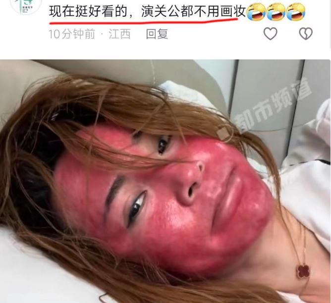 吉林一37岁女子22年化妆不卸妆，只是用清水洗洗就算完事，如今脸部重度过敏，红到