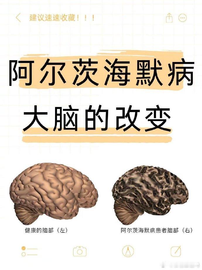 国产阿尔茨海默病新药停产引关注，患者断药困境亟待解决。盼厂家速行动，家人亦多陪伴