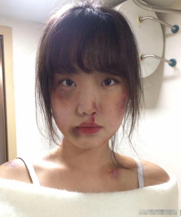 四十二岁的李娟刚遭到丈夫用皮带殴打，身上的伤还没有恢复，婆婆就找上门来劝她宽容退