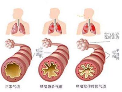 呼吸专家告诉你冬季老年哮喘如何预防与治疗