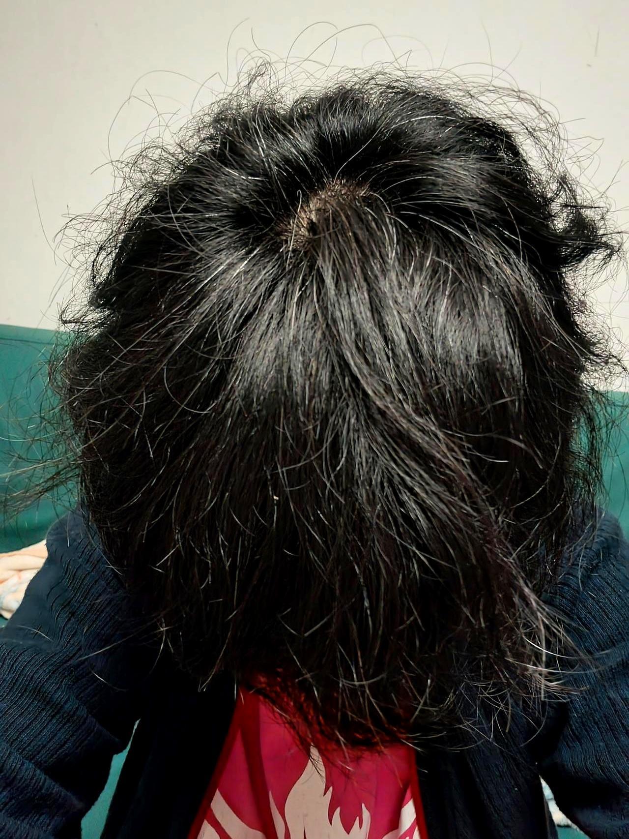 81年的我，白发遗传，不遮不盖，一根根拔，拔完照照镜子，像给时间剪指甲。77年的