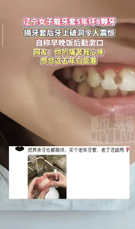 最担心的事还是发生了！辽宁一女子把戴了5年的牙套摘掉后，发现有8颗牙齿出现破洞，