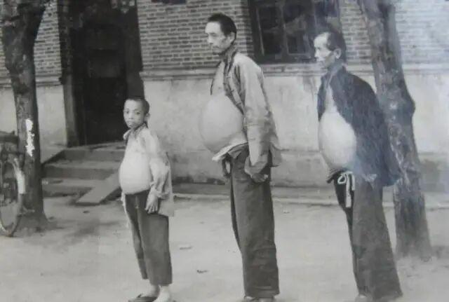 一张老照片里的三代病痛，血吸虫病害了半个中国的农民，1956年江苏镇江拍的老照片