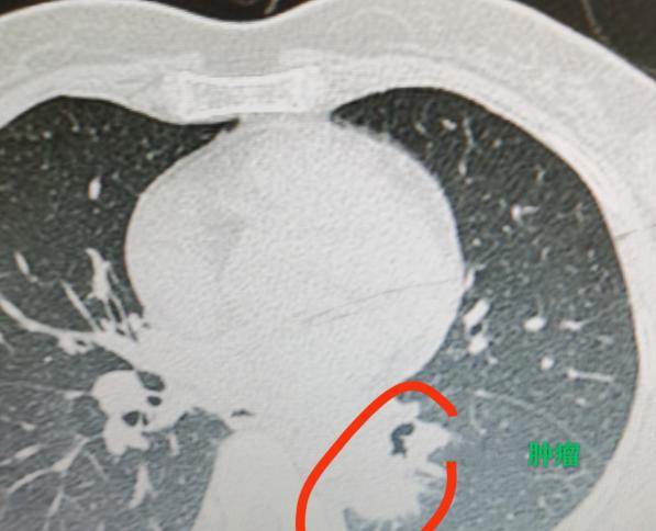 晚期肺癌也能搏手术机会？前段时间接诊了一位40岁的女患者，印象特别深。她是在丈夫