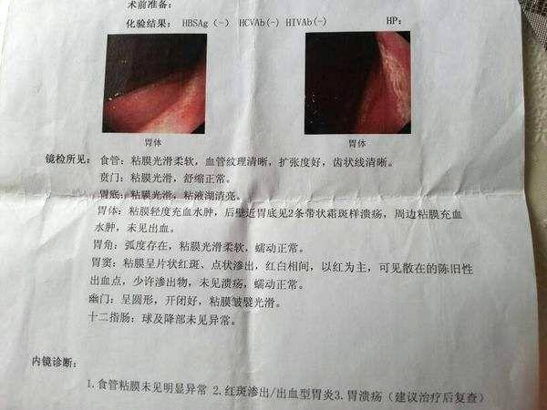 十二脂肠溃疡好治疗吗