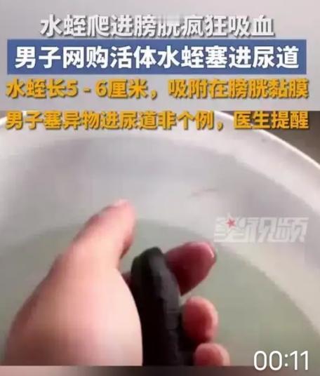 5厘米水蛭塞进尿道！偏方害惨23岁小伙，这些致命谣言该停了23岁的小郑怎么