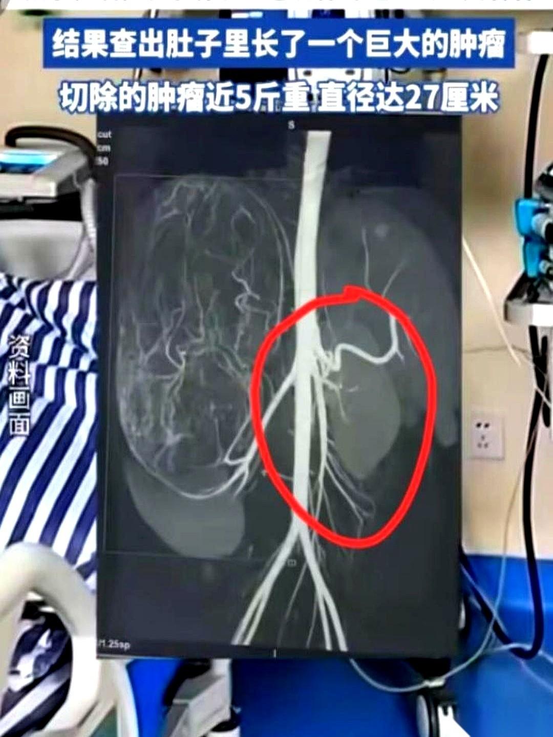 17岁的婷婷，一米六几的个子，体重只有80多斤，瘦得像根竹竿。她就去服装店试了